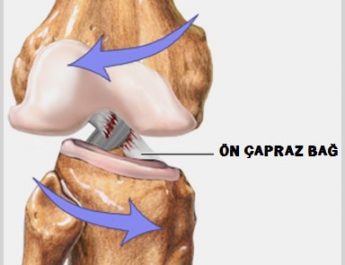 ön çapraz bağ kopması