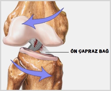 ön çapraz bağ kopması