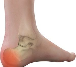topuk ağrısı,gençlerde topuk ağrısı