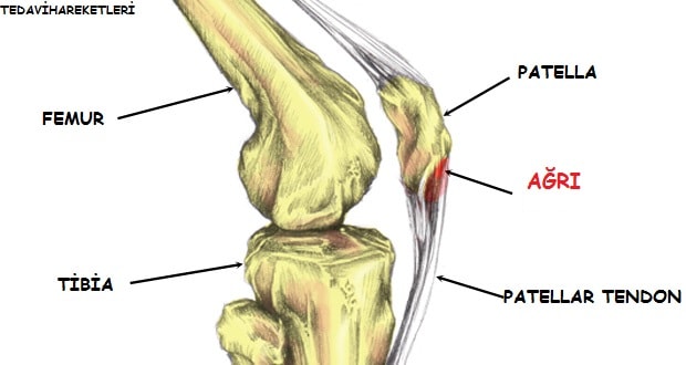 diz ağrısı,patellar tendinopati