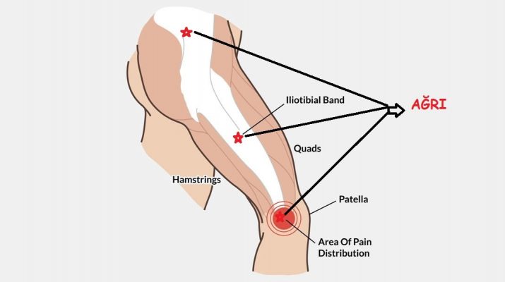 iliotibial band sendromu