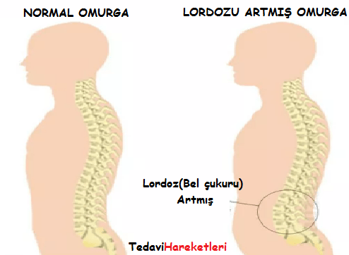 lordoz,bel ağrısı
