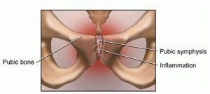 osteitis pubis
